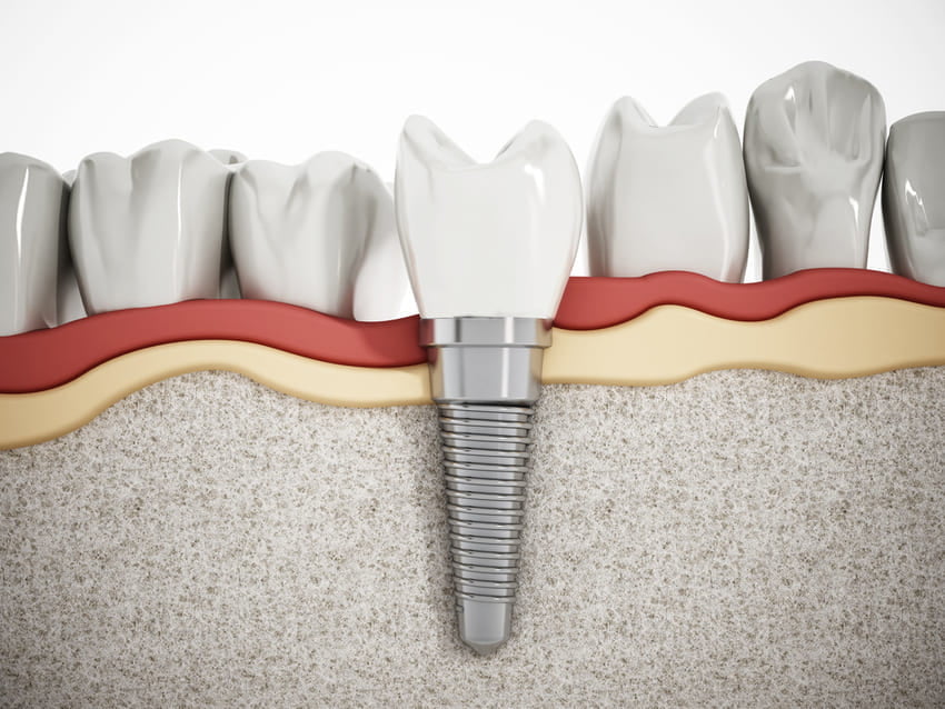 Dijagram zubnog implantata